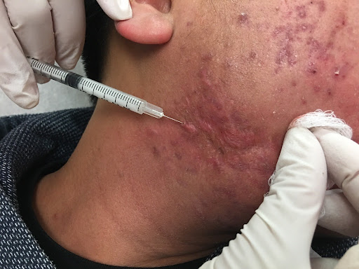 Acne/Keloid Injection