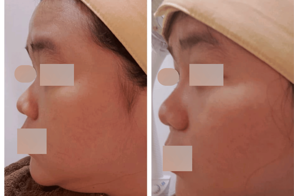 Ameris Perfect Nose Threads Lift Signature (8 Benang)
