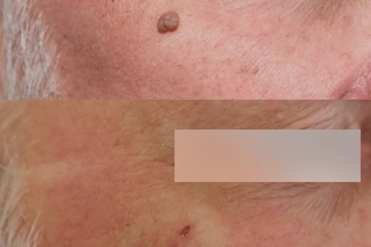 Cauter Skintag 1-5 (Small)