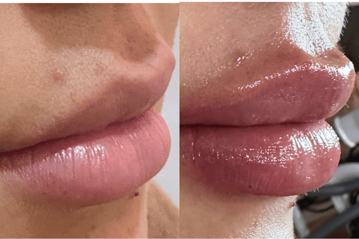 Lip Filler