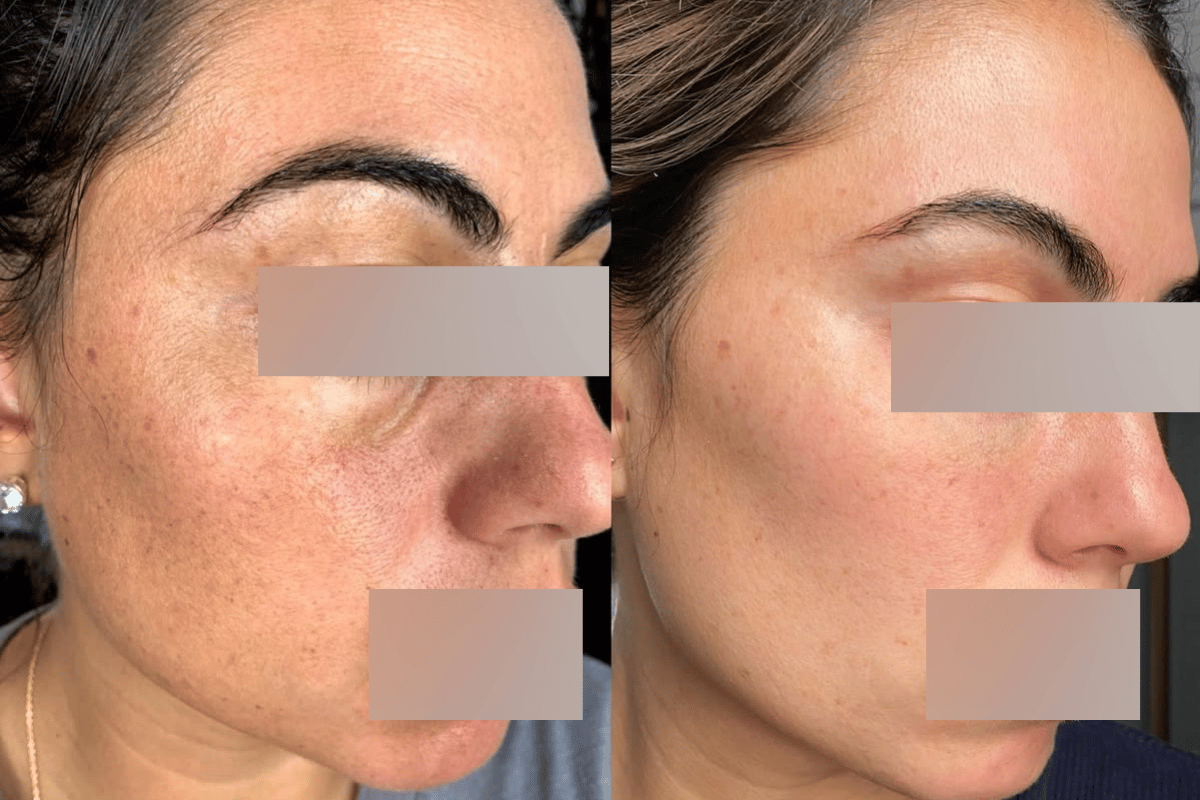 PRP Skin Rejuvenation