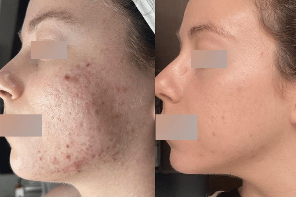 PRP Acne Scar Repair