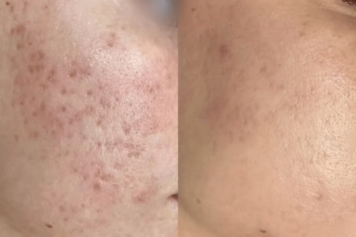 PRP Acne Scar + Subsisi Scar