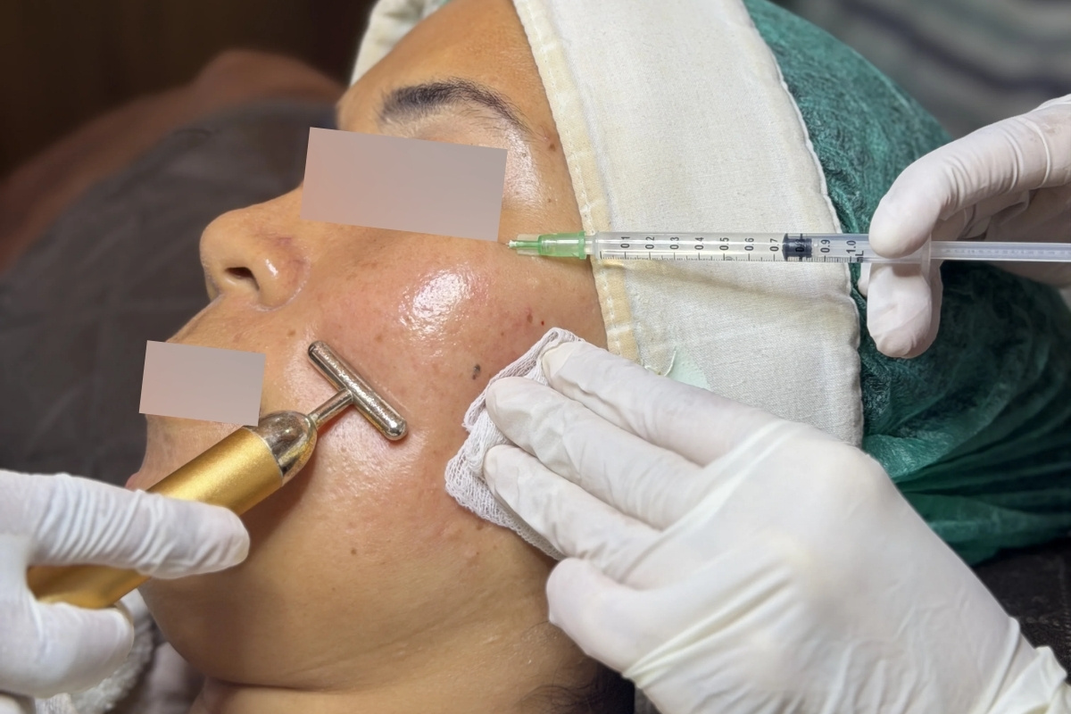 Meso Melasma