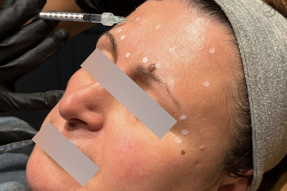 Microbotox Korea