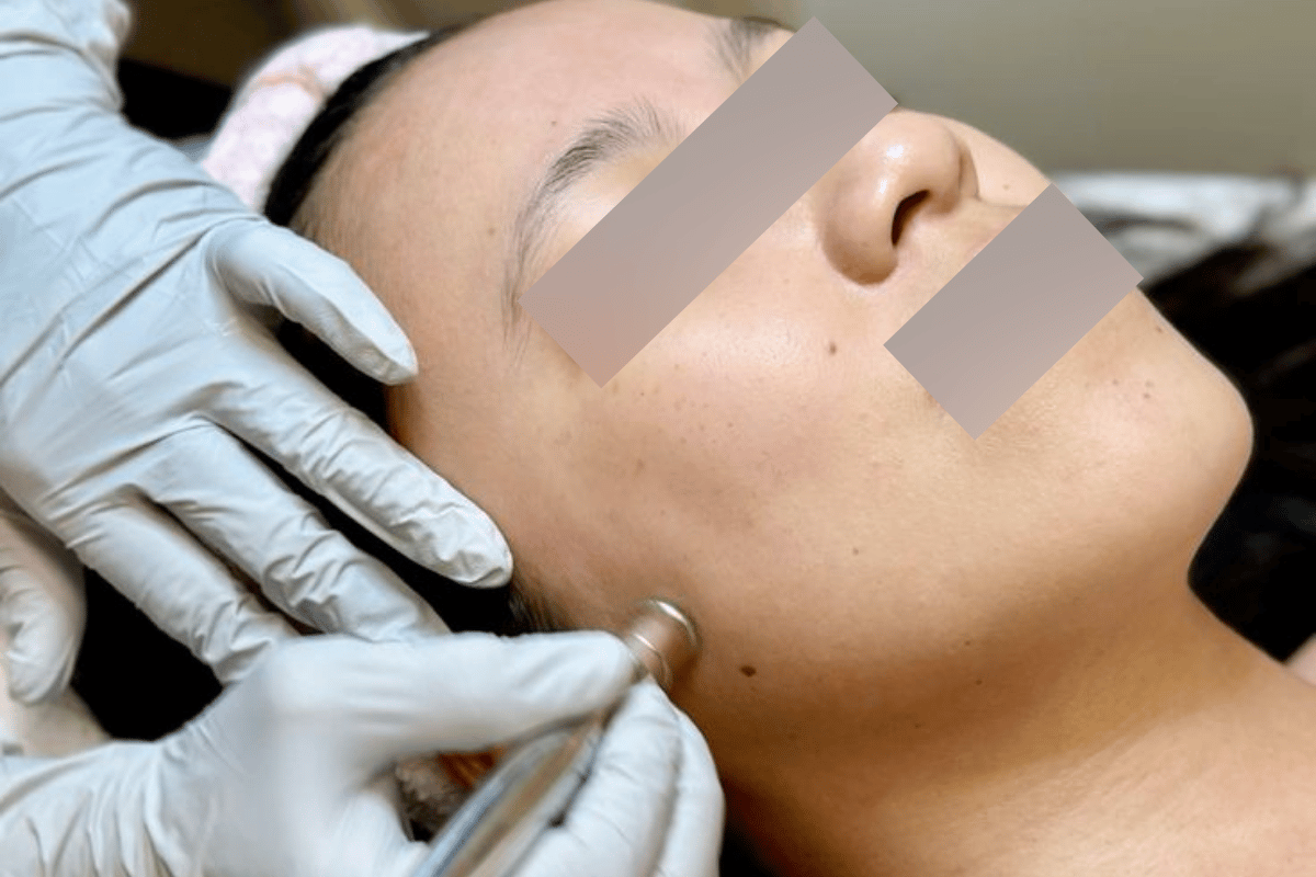 Microdermabrasi
