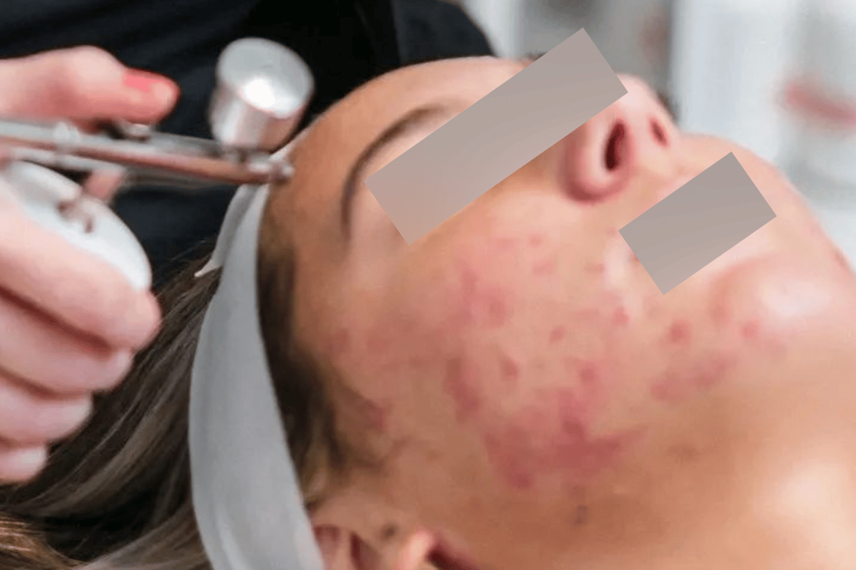 Oxy Infusion (Acne/Brightening)