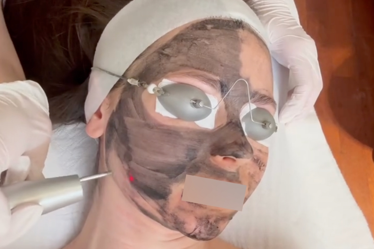 Skin Rejuvenation Picolaser