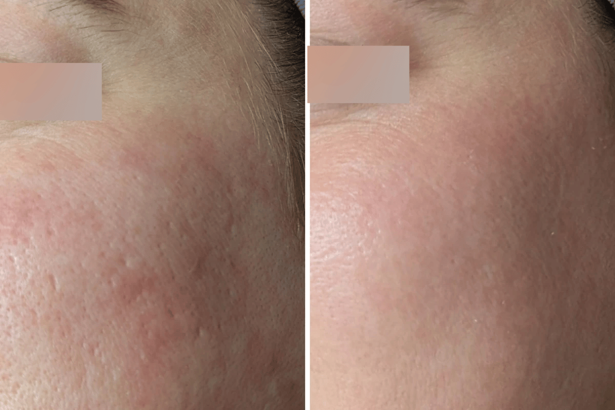 PRP Acne Scar + Subsisi Scar Paket 2x