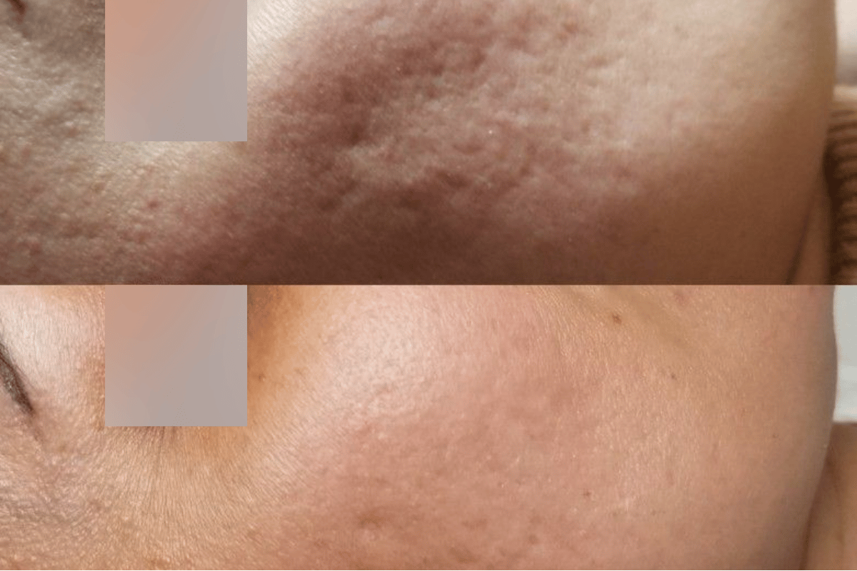 PRP Acne Scar + Subsisi Scar Paket 3x