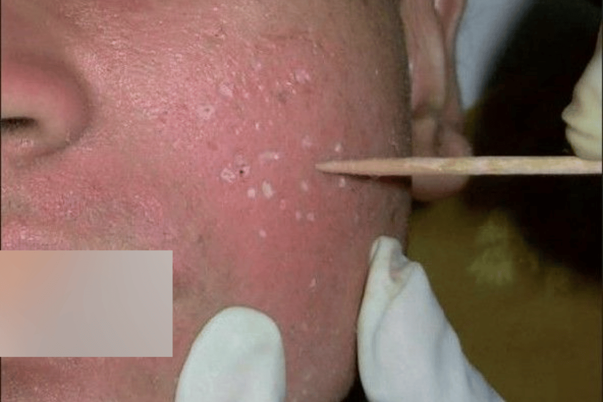 PRP Acne Scar + Subsisi Scar + TCA Cross