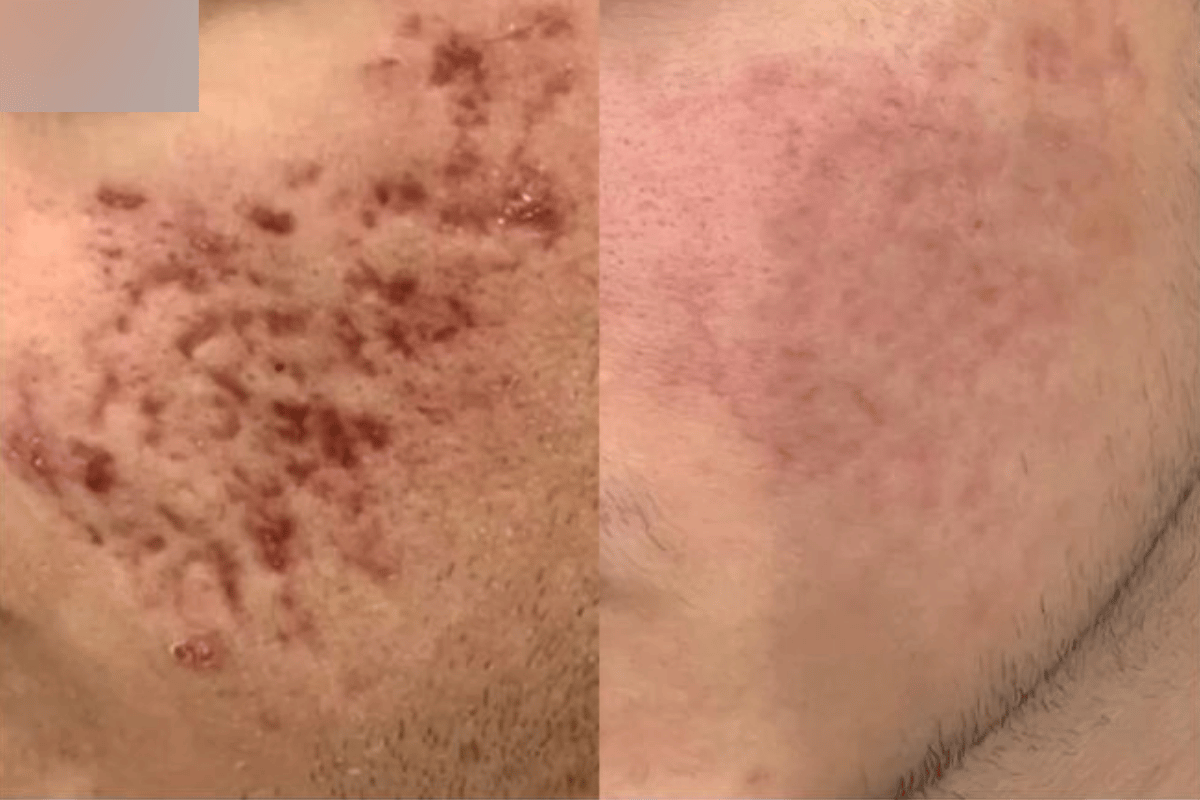 PRP Acne Scar + Subsisi Scar + TCA Cross Paket 2x