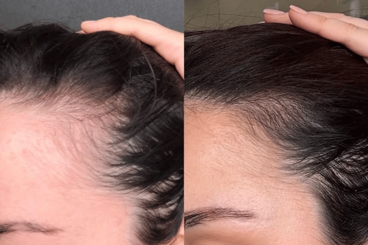 PRP Hair Regrowth