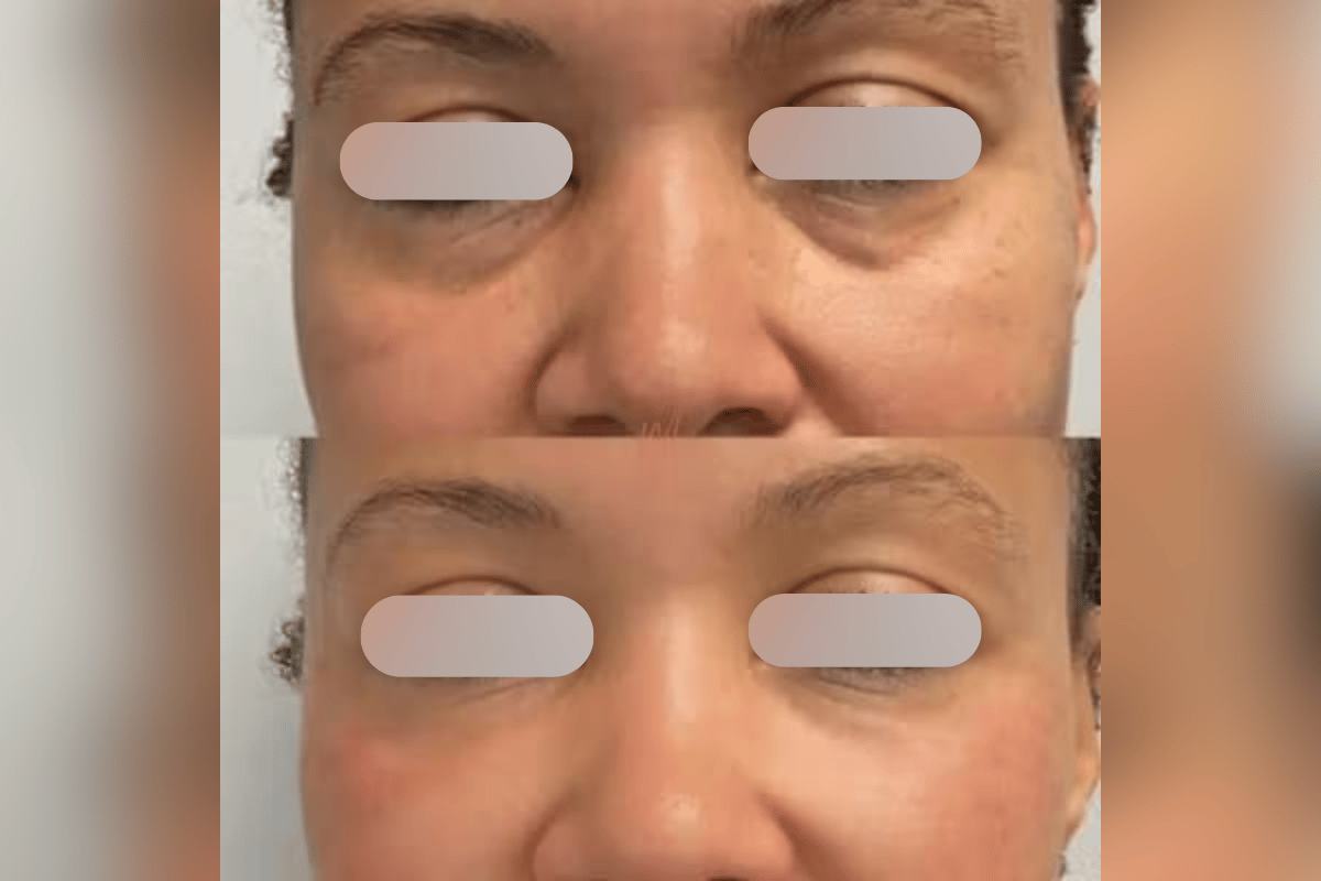 PRP Under Eye Rejuvenation